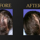 PRF for Hair Restoration