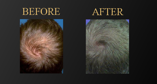 PRF for Hair Restoration