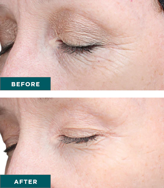 VI Peel Advanced before and after